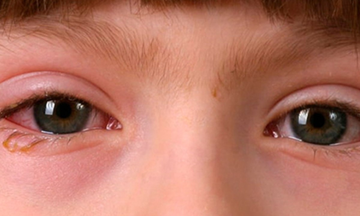 Una de las enfermedades más comunes y que pueden propagarse rápidamente entre los niños es la conjuntivitis.