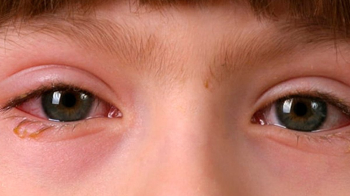 Una de las enfermedades más comunes y que pueden propagarse rápidamente entre los niños es la conjuntivitis.