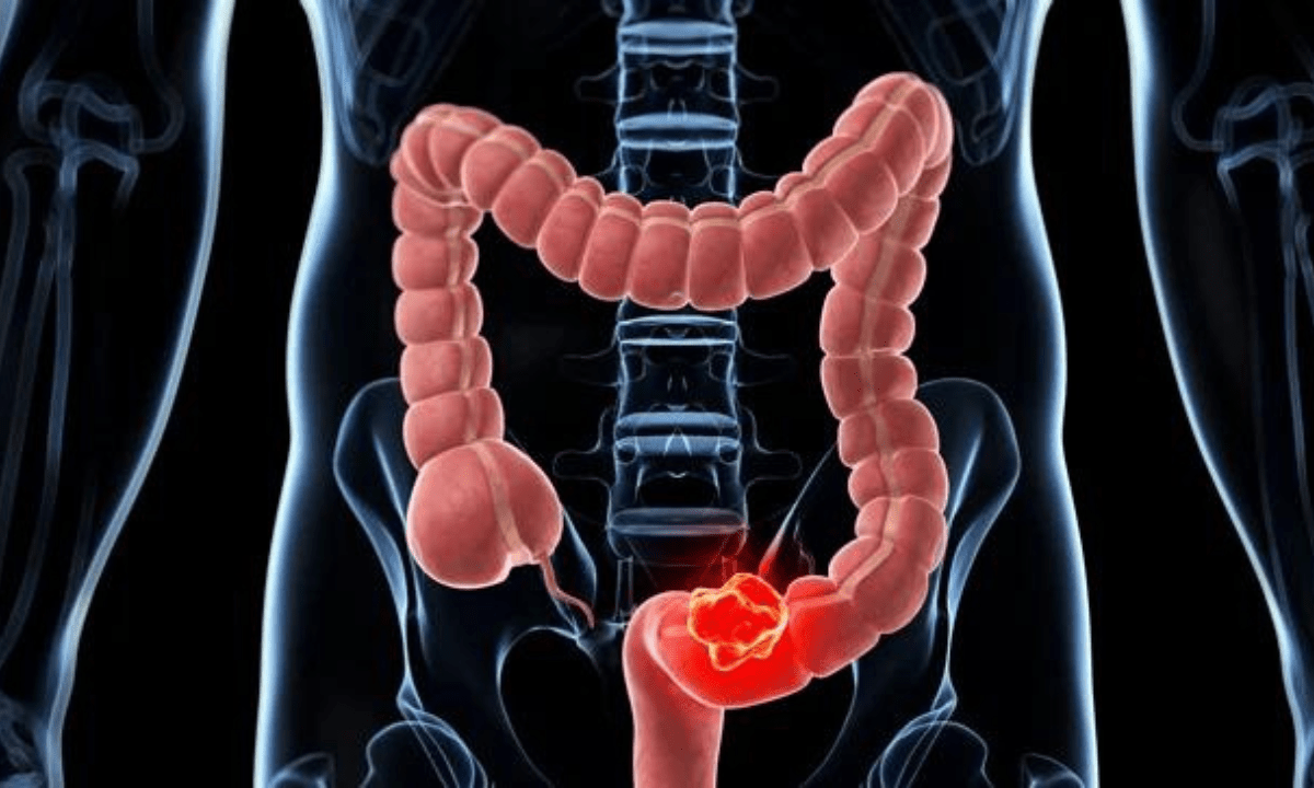 síntomas del cáncer de colon