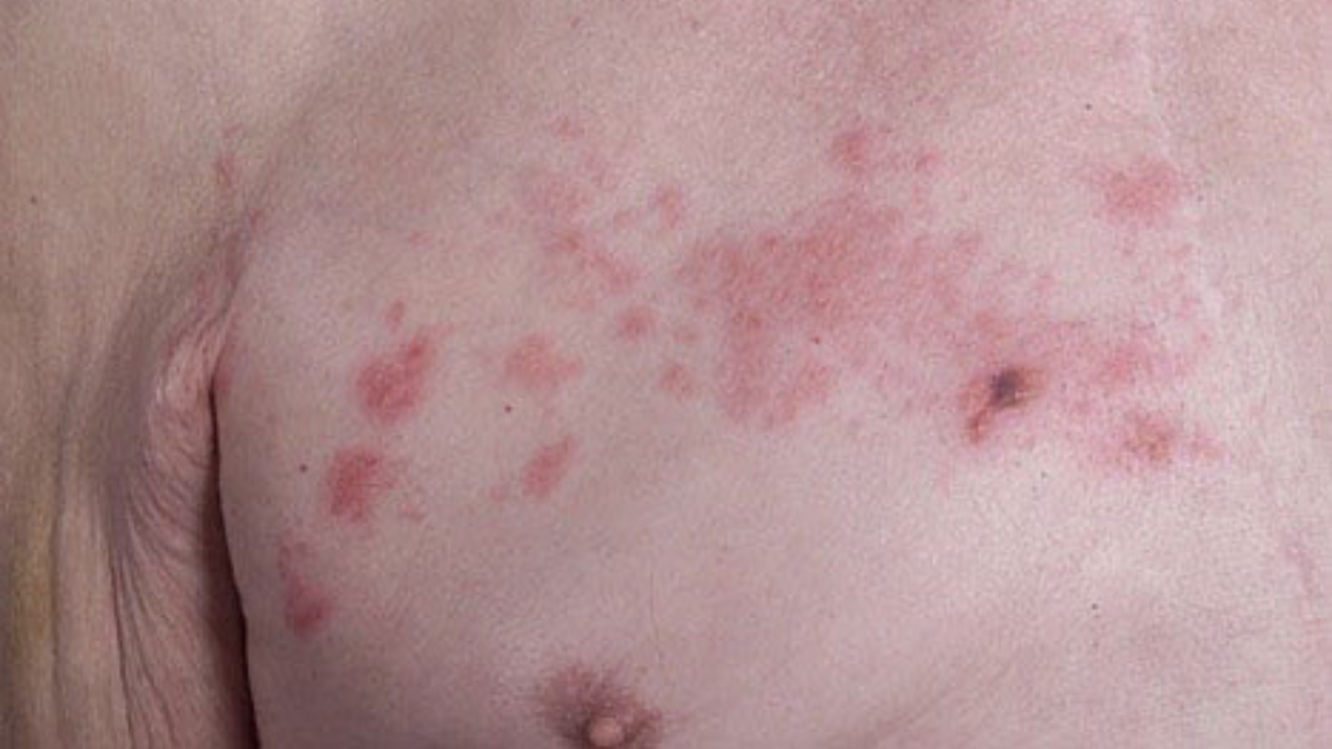 Herpes zóster: síntomas, diagnostico y tratamiento