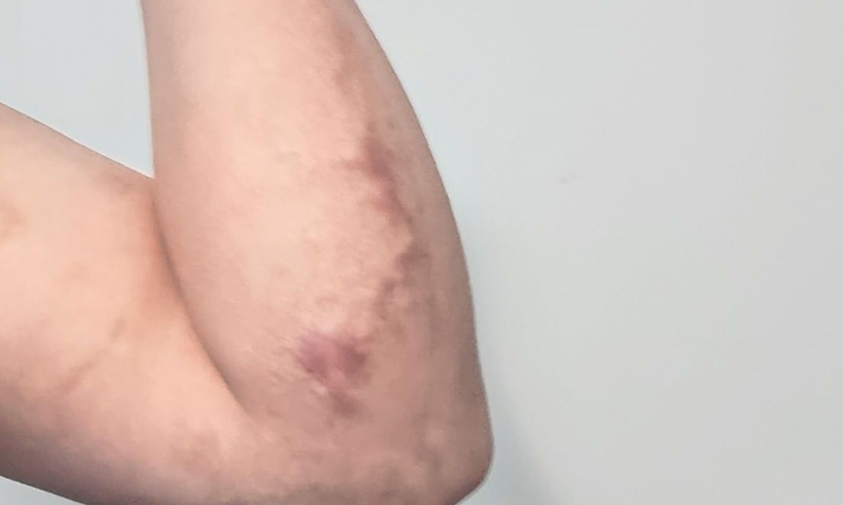 Heridas. El brazo y la espalda de Brayan quedaron marcados para siempre la noche del 27 de marzo de 2023.