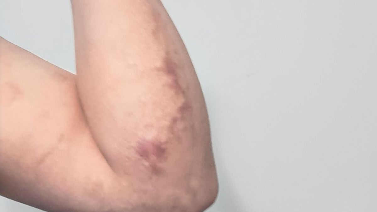 Heridas. El brazo y la espalda de Brayan quedaron marcados para siempre la noche del 27 de marzo de 2023.