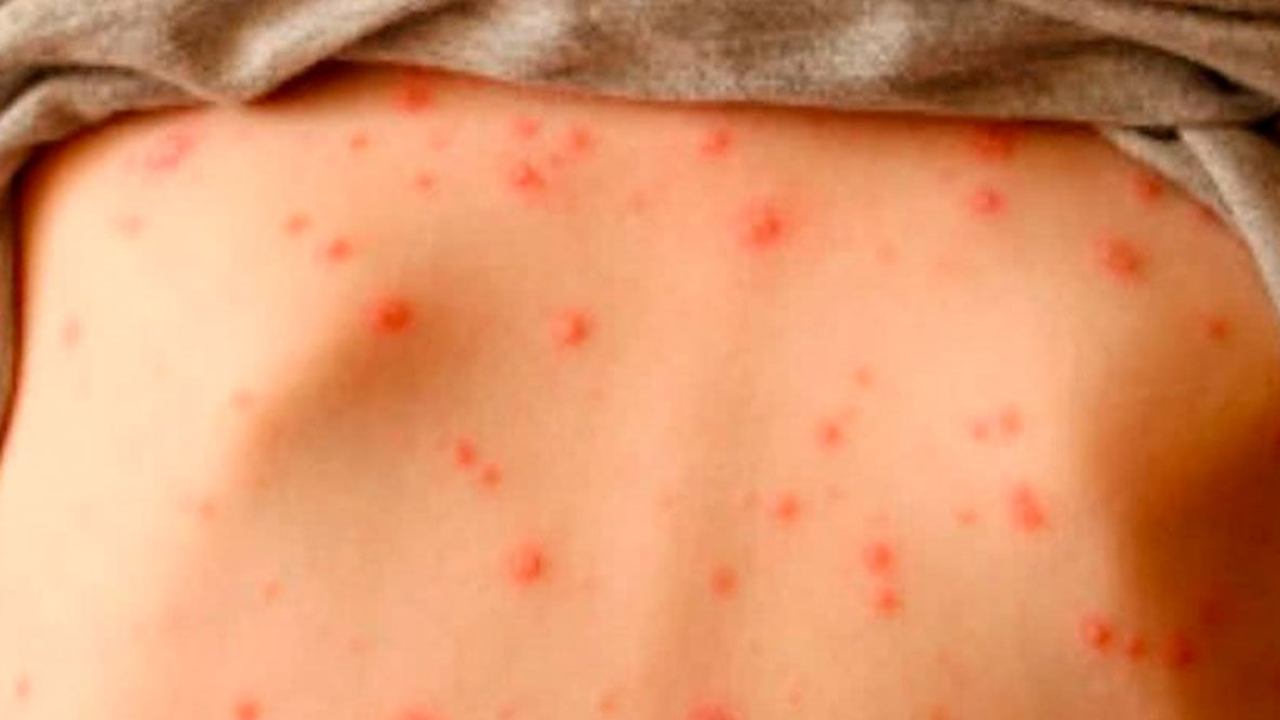 El sarampión también puede causar complicaciones graves, como neumonía y encefalitis (inflamación del cerebro)