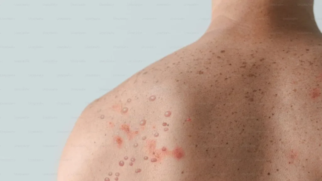 El sarampión es una enfermedad altamente contagiosa que requiere aislamiento y puede ameritar incapacidad médica temporal.