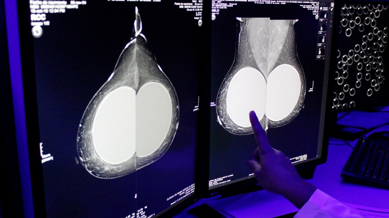 Alerta aseguradora que creció pago de coberturas por cáncer