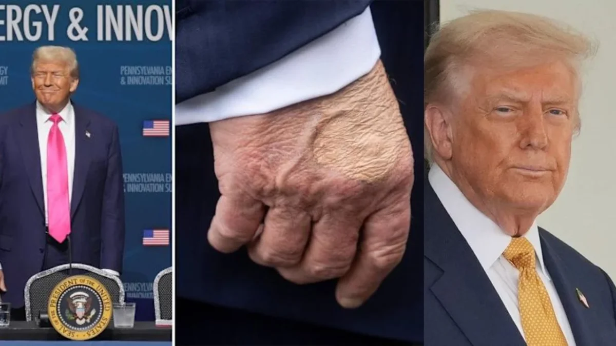 Diagnostican a Trump con insuficiencia venosa crónica tras varios estudios