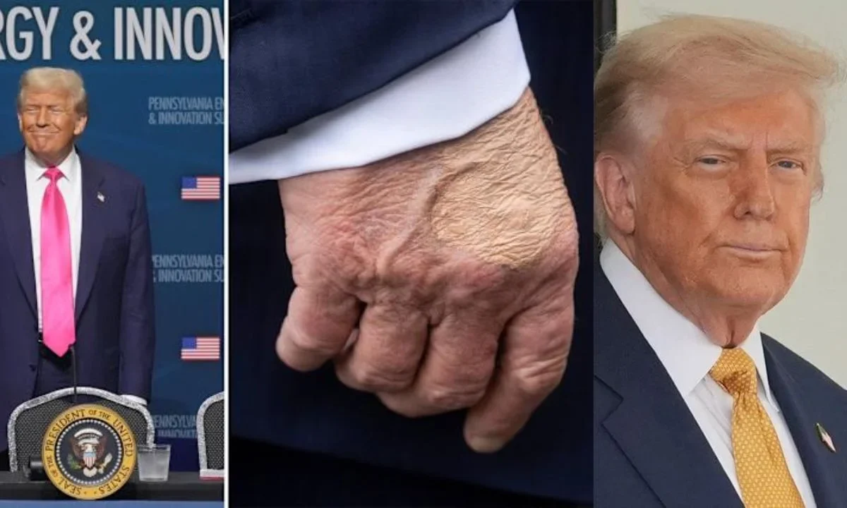 Diagnostican a Trump con insuficiencia venosa crónica tras varios estudios