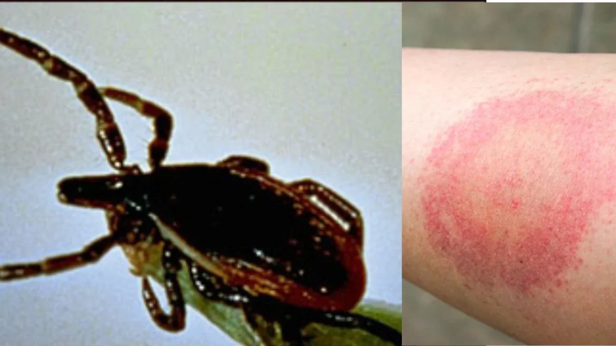 ¿Cómo prevenir la enfermedad de Lyme? Checa estas recomendaciones