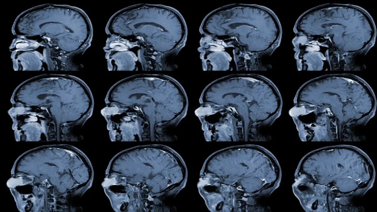 El aneurisma cerebral puede pasar desapercibido durante años, pero su detección temprana resulta clave para prevenir una hemorragia grave.