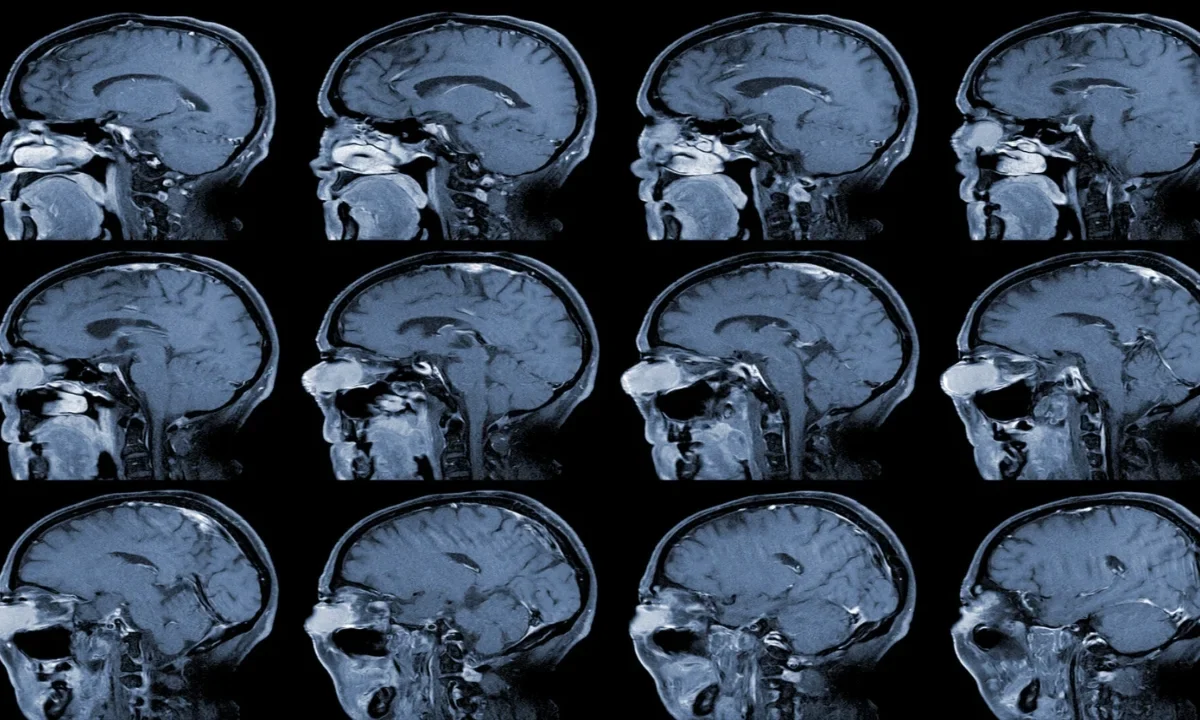 El aneurisma cerebral puede pasar desapercibido durante años, pero su detección temprana resulta clave para prevenir una hemorragia grave.