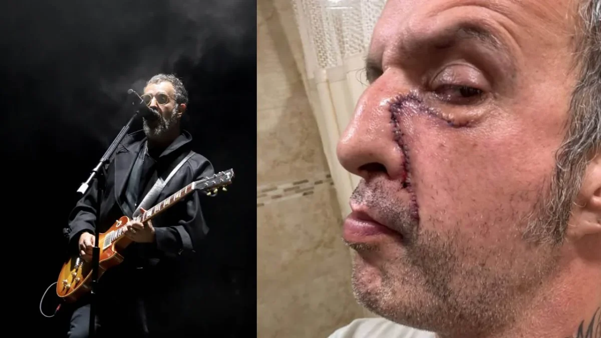 Tito Fuentes, integrante de la banda Molotov, compartió en sus redes sociales cómo luce su rostro luego de pasar por varías cirugías.