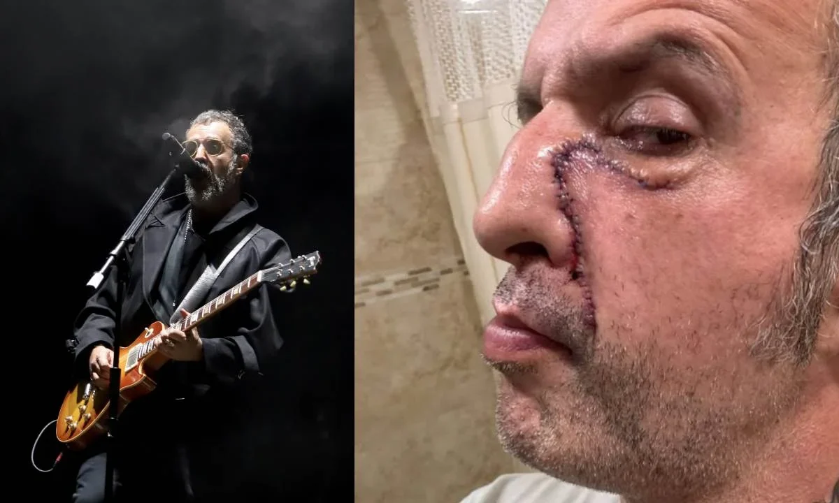 Tito Fuentes, integrante de la banda Molotov, compartió en sus redes sociales cómo luce su rostro luego de pasar por varías cirugías.