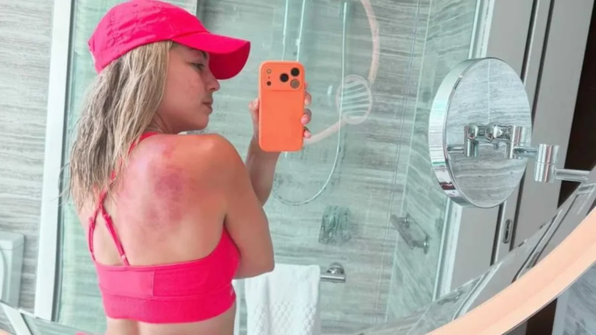 La mexicana Renata Zarazúa sufre heridas por el Sol de Australia.