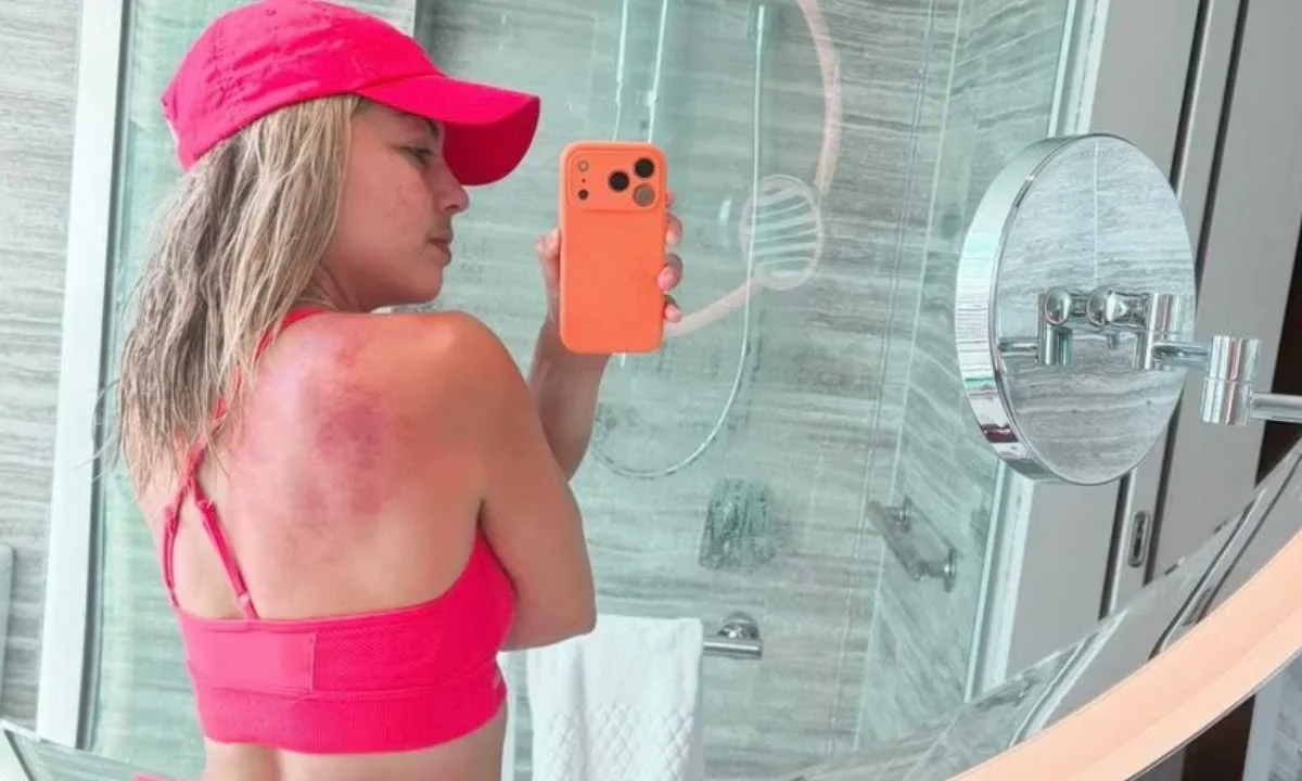 La mexicana Renata Zarazúa sufre heridas por el Sol de Australia.