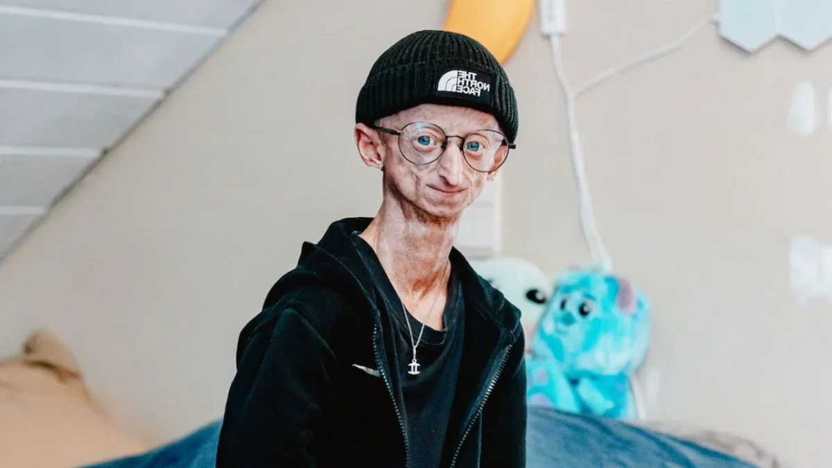 Michiel Vandeweert, influencer belga de 28 años quien padeció progeria, murió pero deja una historia al afrontar la rara enfermedad.